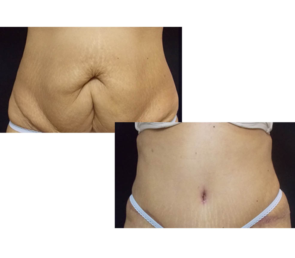 Abdominoplastía